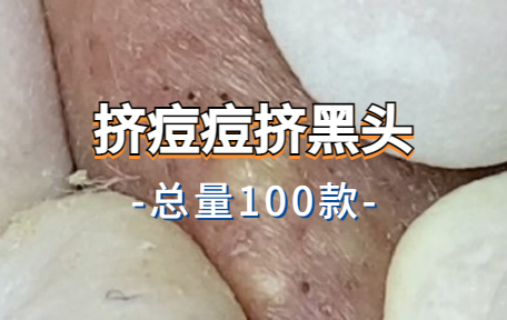 【100款】挤痘痘挤黑头解压视频素材-零八素材网