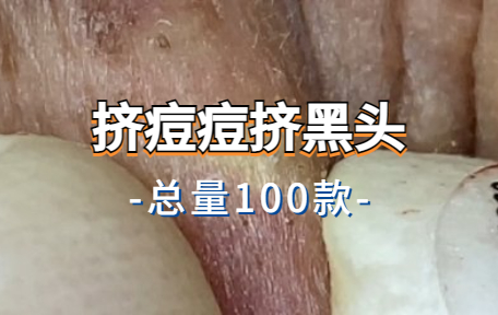 【100款】挤痘痘挤黑头解压视频素材-零八素材网