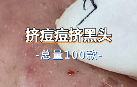 【100款】挤痘痘挤黑头解压视频素材-零八素材网