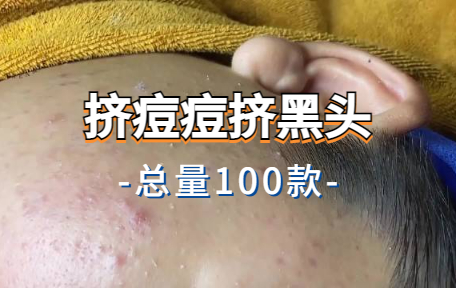 【100款】挤痘痘挤黑头解压视频素材-零八素材网