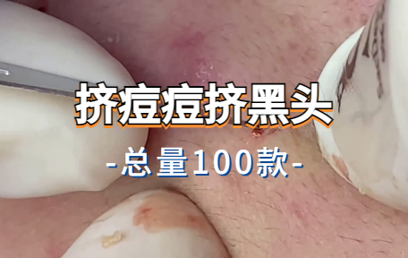 【100款】挤痘痘挤黑头解压视频素材-零八素材网